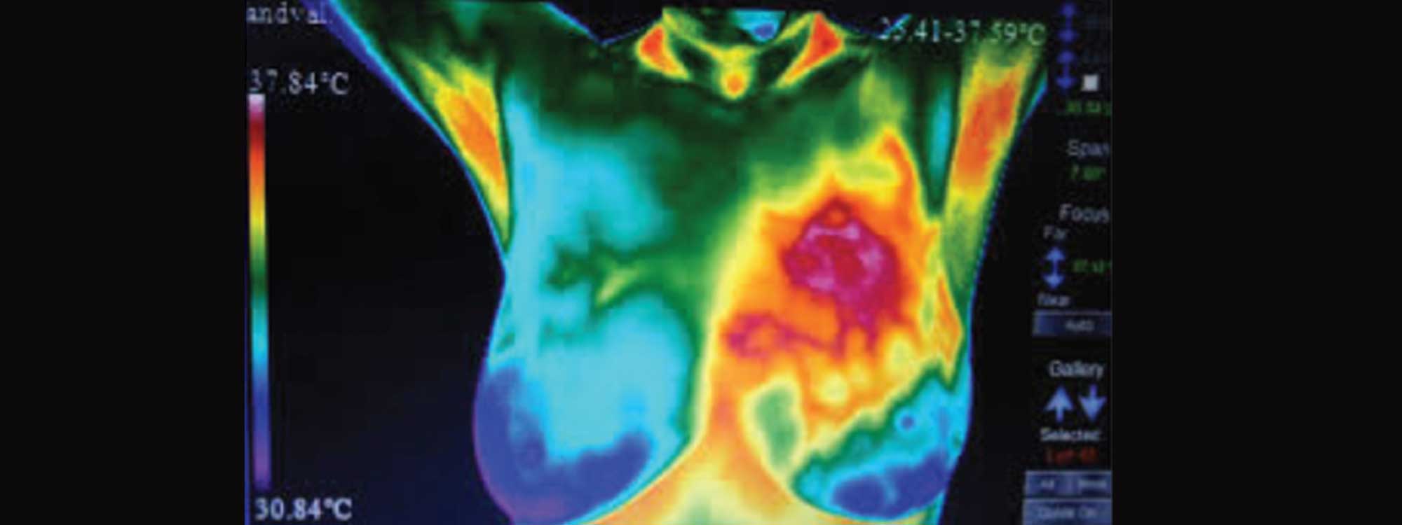 Thermography Breast Cancer